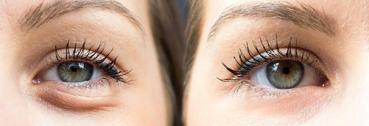 Bild vor und nach der Unterlidstraffung